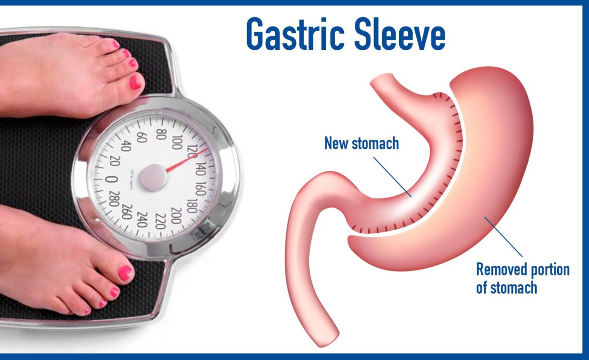 Ce presupune gastric sleeve: stomac micșorat chirurgical și scădere în greutate după intervenția bariatrică