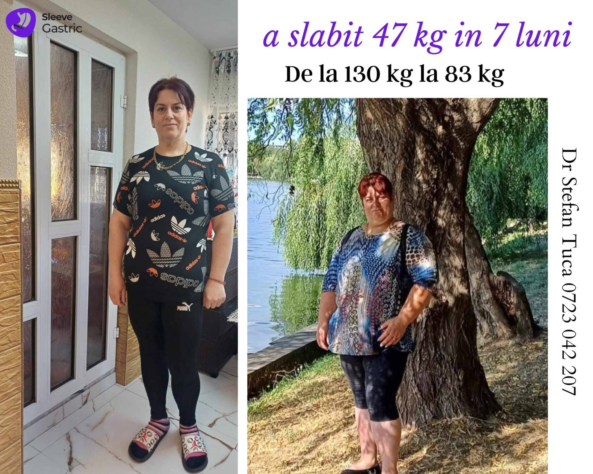 pacienta gastric sleeve