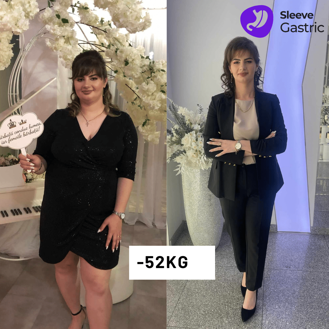 gastric sleeve pacient