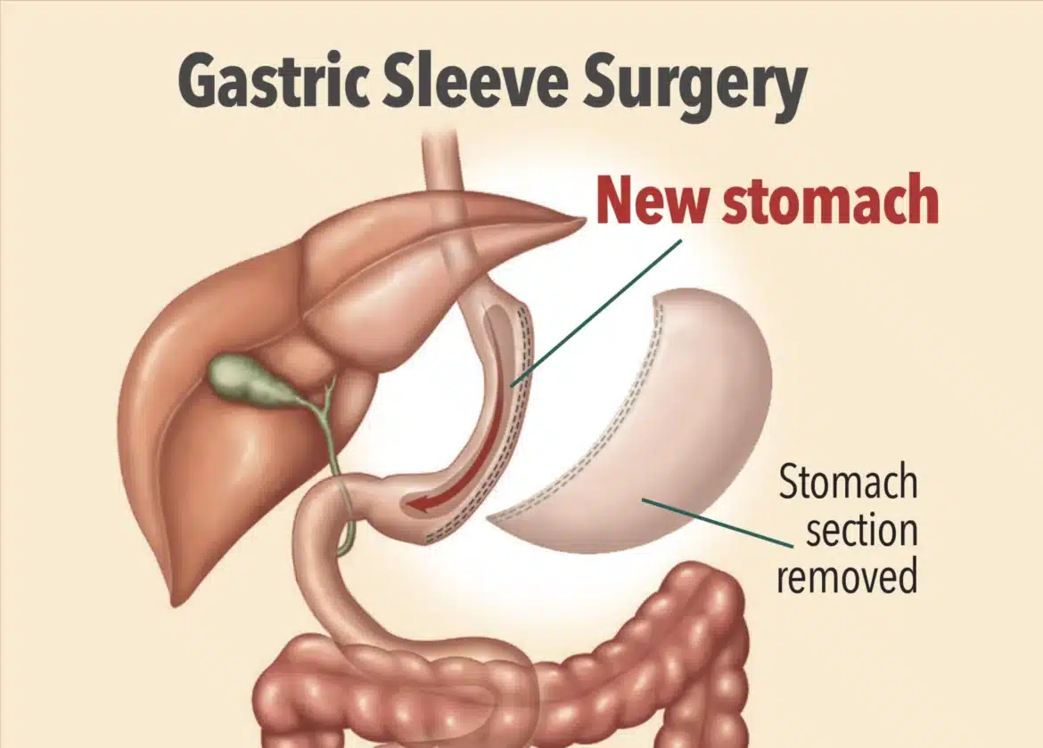 Chirurgia bariatrică – reducerea stomacului și noile conexiuni digestive