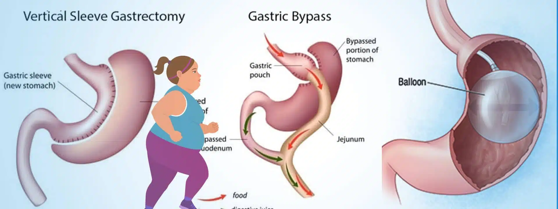 Chirurgia laparoscopică bariatrică – intervenție sigură pentru controlul obezității Chirurgia laparoscopică bariatrică – tehnică modernă cu incizii minime