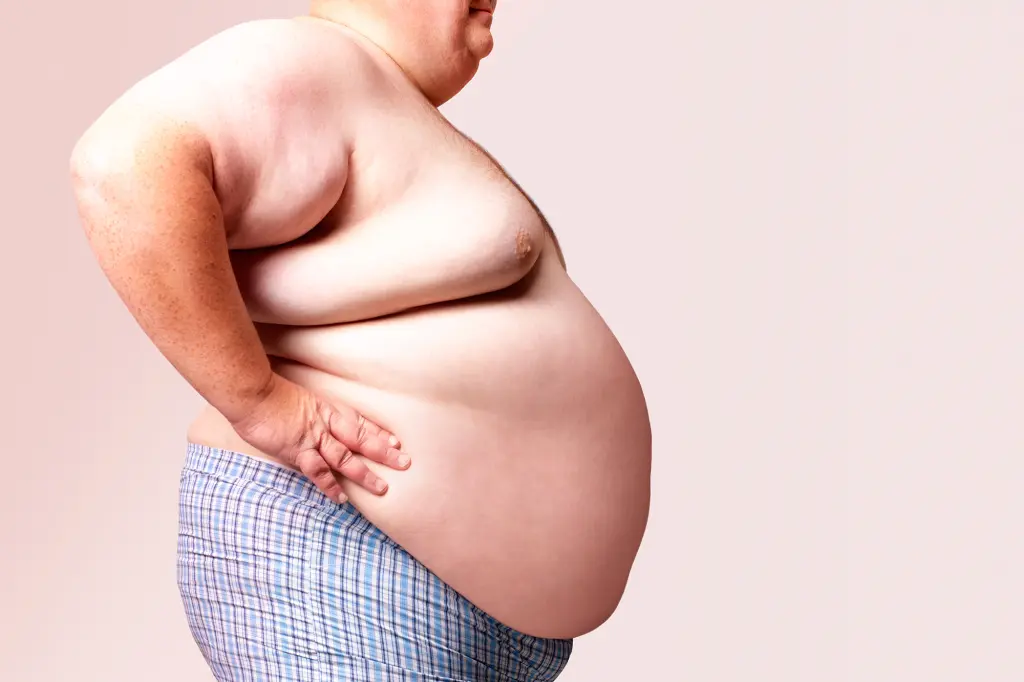 Pacient cu obezitate severă care ar putea beneficia de chirurgie bariatrică, profil lateral