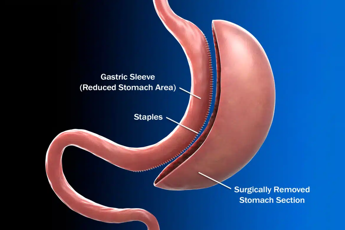 Imagine explicativă a procedurii Gastric Sleeve – porțiunea redusă a stomacului și zona îndepărtată chirurgical