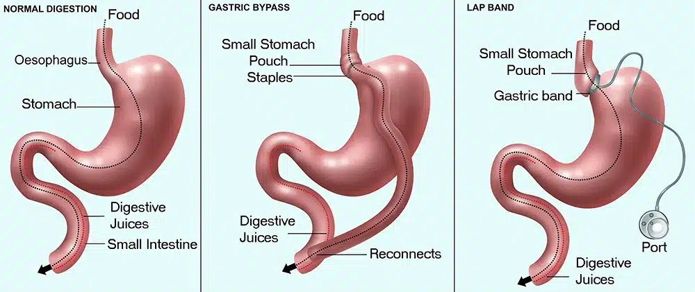 Modificări digestive după chirurgia bariatrică: digestie normală, gastric bypass, inel gastric