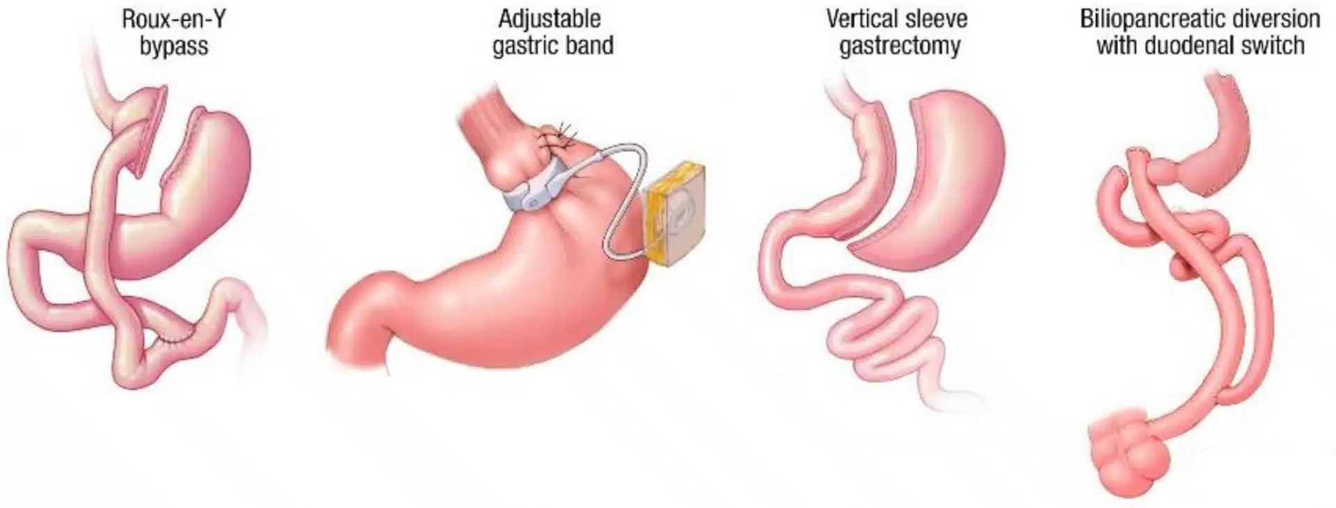 Tipuri de intervenții în chirurgia bariatrică Tipuri de intervenții bariatrice: gastric sleeve, bypass gastric, inel gastric, diversie biliopancreatică