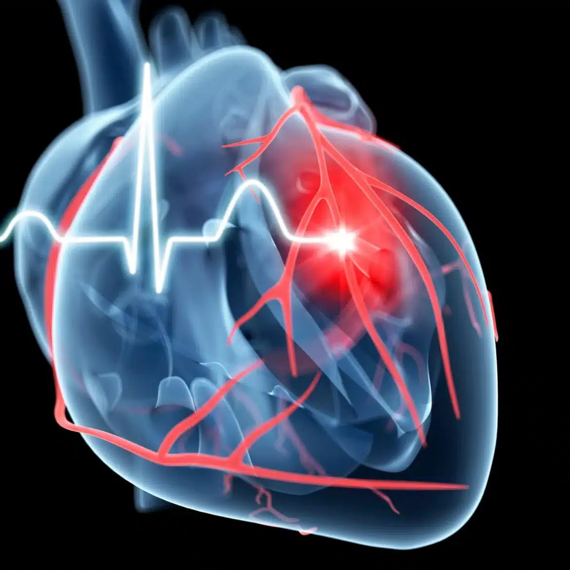 Ilustrație a inimii cu afectare coronariană și inflamație, reprezentând riscul cardiovascular din obezitate
