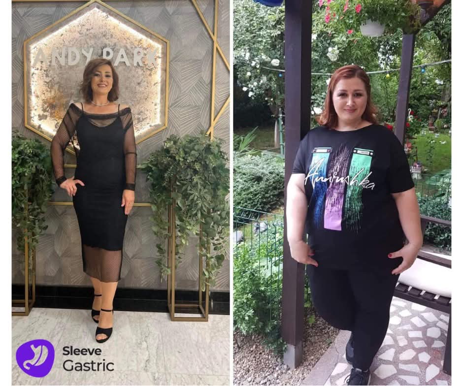 Transformare reală înainte și după operația de micșorare a stomacului (Gastric Sleeve), pacienta cu scădere semnificativă în greutate