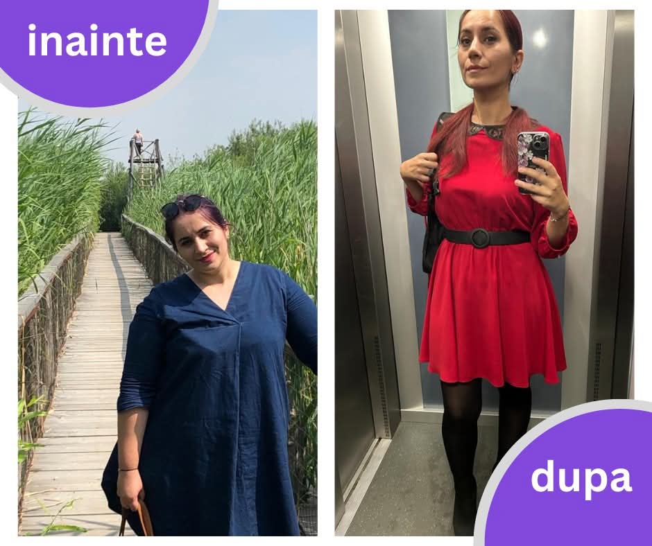Rezultate reale înainte și după operația Gastric Sleeve, scădere masivă în greutate după micșorarea stomacului