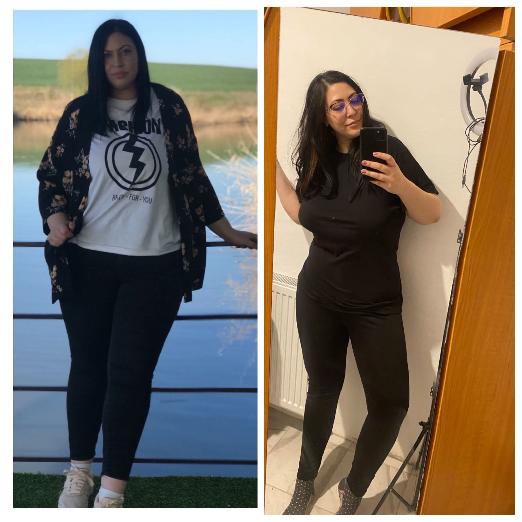 Imagine reală înainte și după micșorarea stomacului prin operația Gastric Sleeve, pacienta după scădere semnificativă în greutate