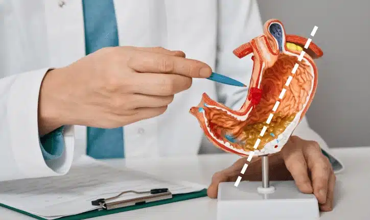 Model anatomic al stomacului care arată linia de secțiune în operația de gastric sleeve