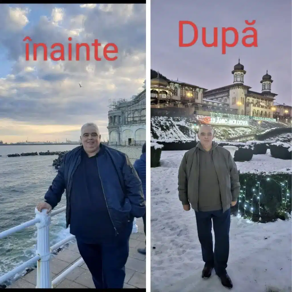 Pacient la un an si jumatate dupa gastric sleeve sub 100 kilograme