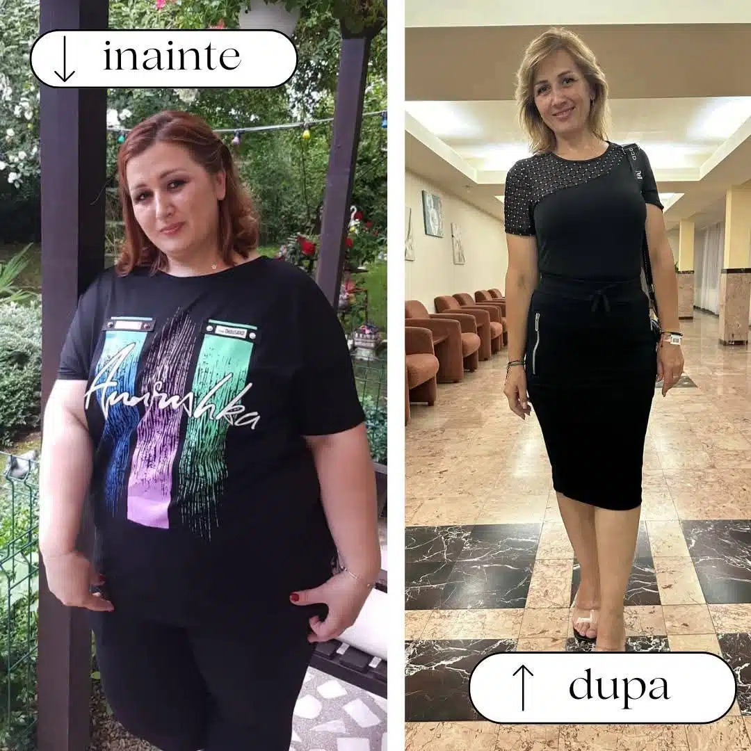 Rezultate înainte și după operația gastric sleeve la o pacientă, cu diferență vizibilă în greutate