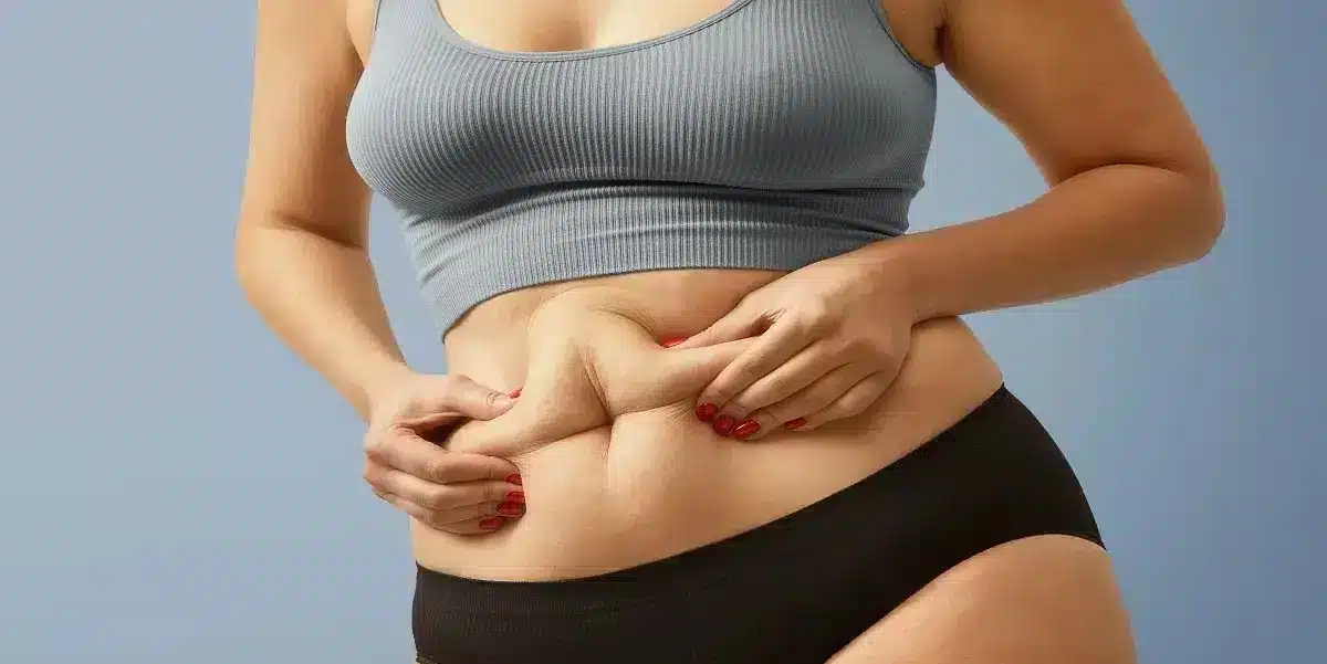 Recuperare după gastric sleeve – piele abdominală după scădere în greutate