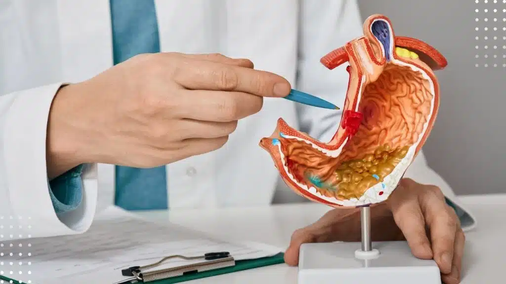 Medicul arată cu pixul un model anatomic al stomacului pentru a explica cum funcționează chirurgia bariatrică