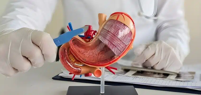 Medicul prezintă un model anatomic al stomacului pentru a explica modul în care funcționează operația gastric sleeve