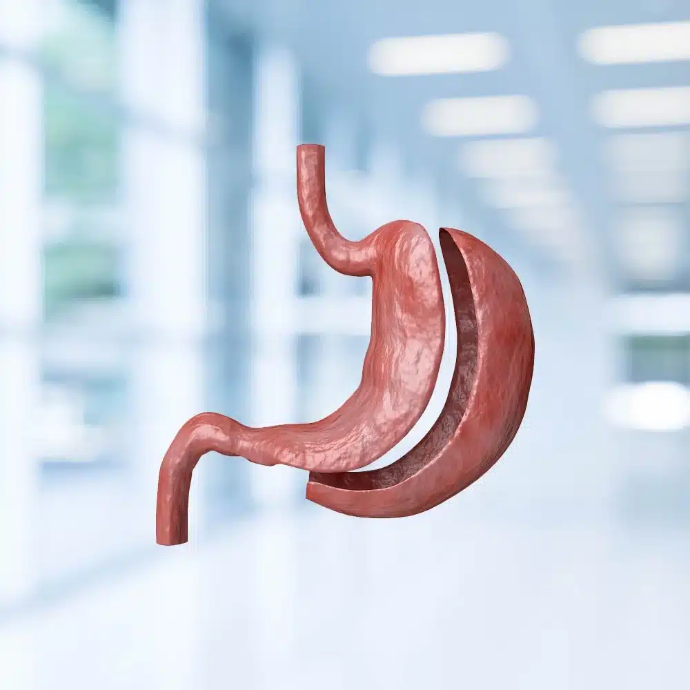 Volumul stomacului după operația de gastric sleeve Imagine 3D a stomacului după operația de gastric sleeve