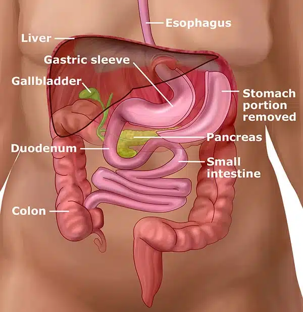 Reprezentare anatomică a operației de micșorare a stomacului (gastric sleeve) și a organelor implicate