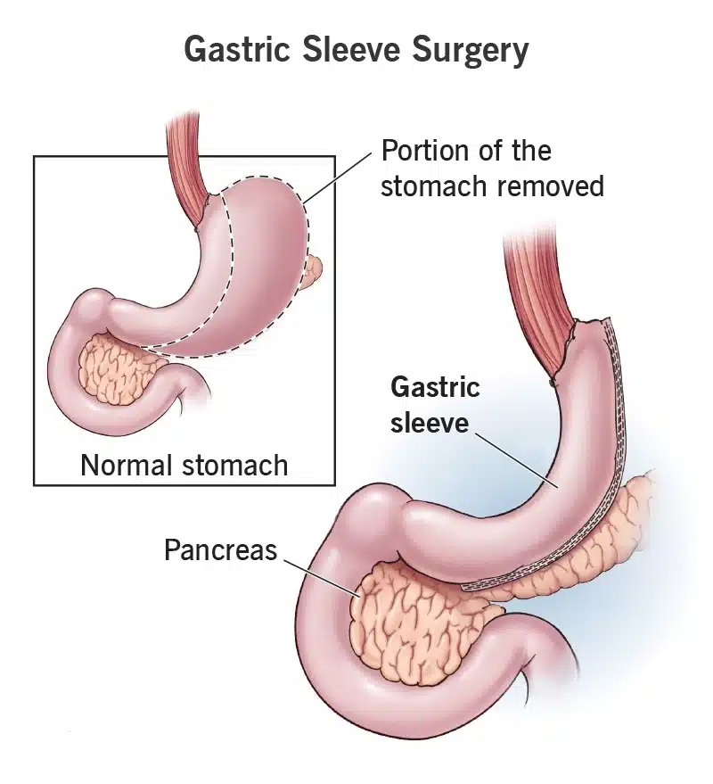 Ilustrație medicală – intervenția de gastric sleeve Reprezentare schematică a intervenției de gastric sleeve