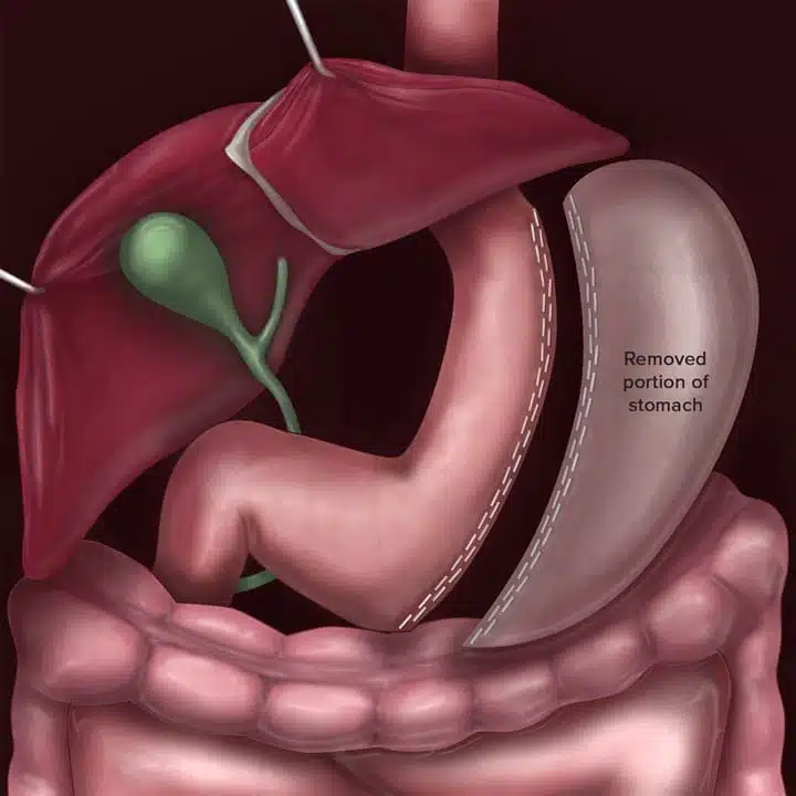 Ilustrație medicală care arată porțiunea de stomac îndepărtată în timpul operației de sleeve gastric