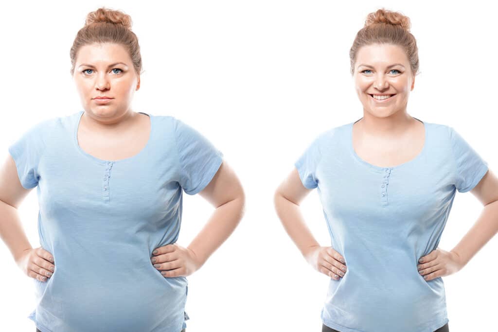 Pacientă înainte și după operația bariatrică, cu reducere vizibilă în greutate