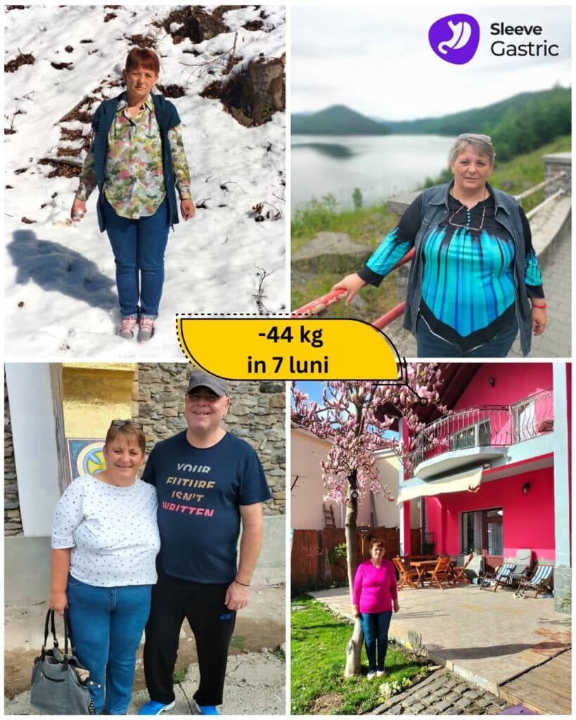Rezultat real după operația de micșorare a stomacului (gastric sleeve), pacientă operată de Dr. Ștefan Tucă – transformare la 7 luni după intervenția bariatrică