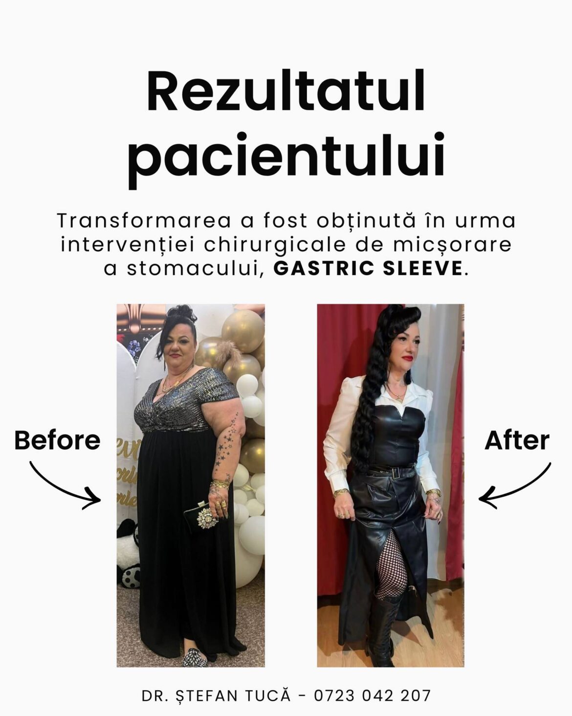 Rezultat real before and after după operația de gastric sleeve, pacientă operată de Dr. Ștefan Tucă – schimbare vizibilă a stilului de viață după chirurgia bariatrică