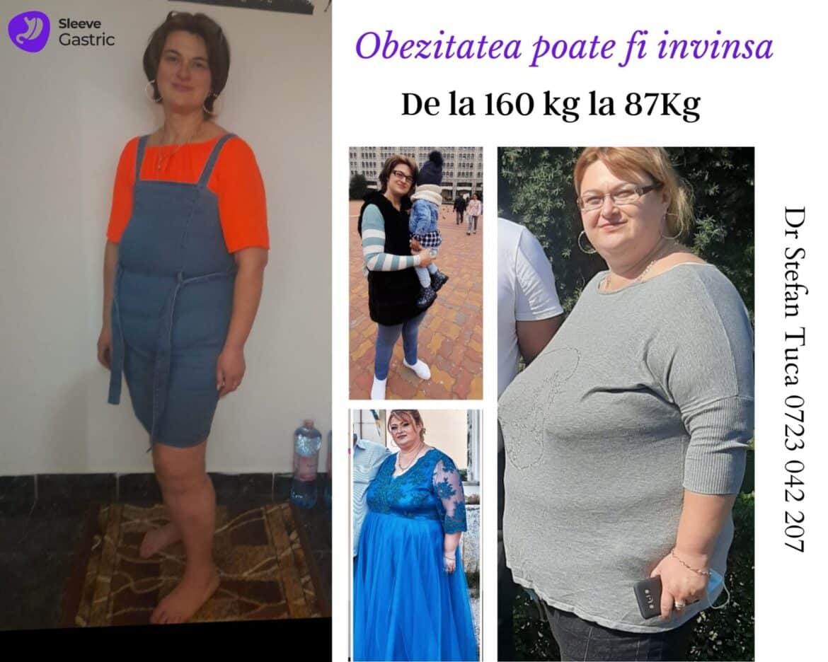 Pacientă operată prin gastric sleeve de Dr. Ștefan Tucă, cu rezultat remarcabil de la 160 kg la 87 kg după micșorarea stomacului.