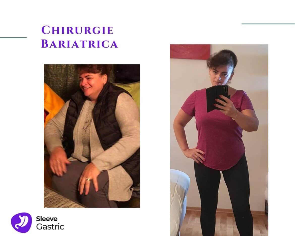 Transformare corporală după chirurgie bariatrică prin gastric sleeve, pacientă operată de dr. Ștefan Tucă
