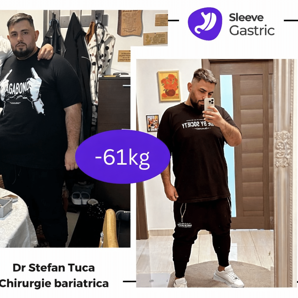 Rezultat înainte și după chirurgia bariatrică, cu scădere ponderală de 61 kg la pacient tratat prin micșorarea stomacului