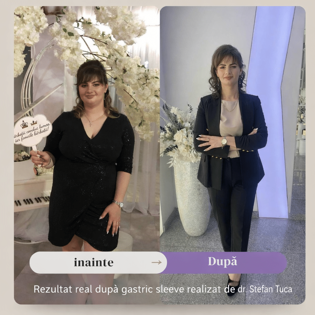 Rezultat real înainte și după gastric sleeve, cu scădere semnificativă în greutate după intervenție realizată de Dr. Ștefan Tucă