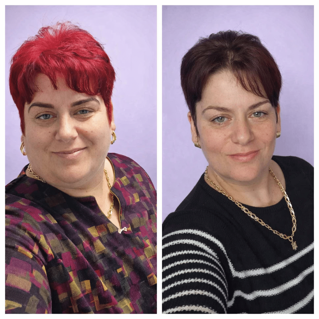 Rezultat înainte și după scăderea în greutate la pacientă operată prin gastric sleeve