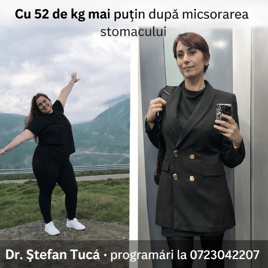 Pacientă reală înainte și după micșorarea stomacului, cu scădere ponderală de 52 de kilograme la un an după operația de gastric sleeve realizată de Dr. Ștefan Tucă