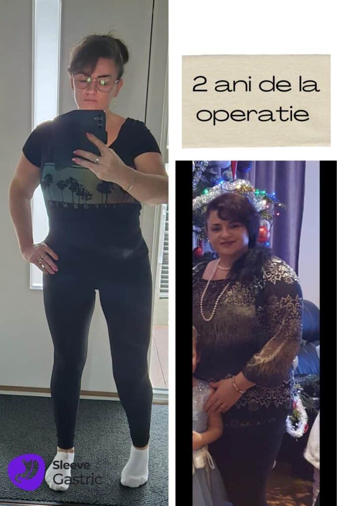 Evoluție la 2 ani după micșorarea stomacului (gastric sleeve) la o pacientă operată de dr. Ștefan Tucă